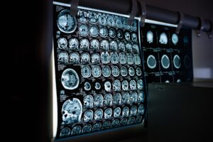 photo of head MRI scan images mounted on a view box in a dark room like radiologists use