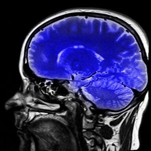 sagittal non-contrast cephalic MRI scan image with a blue colorization of the brain
